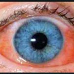 Konjuktivitis (vnetje očesne veznice)